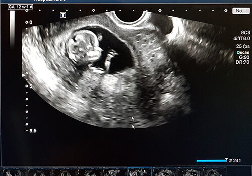 Ultrasound scan