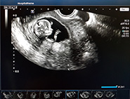 12 week Ultrasound