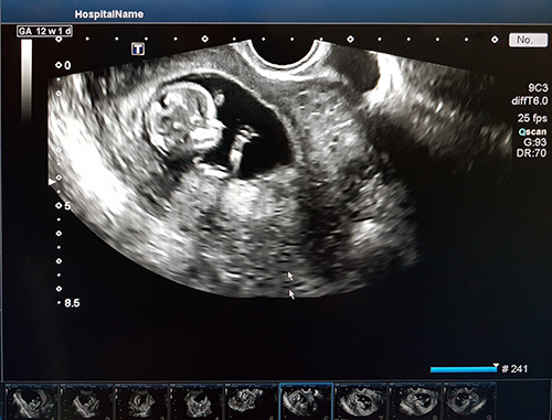 Ultrasound scan