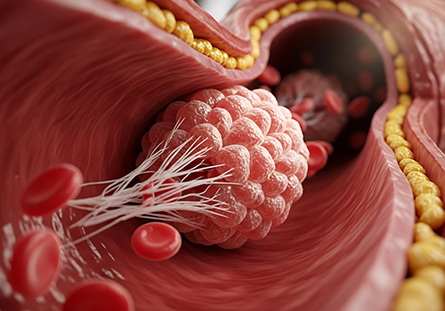 plaque rupture