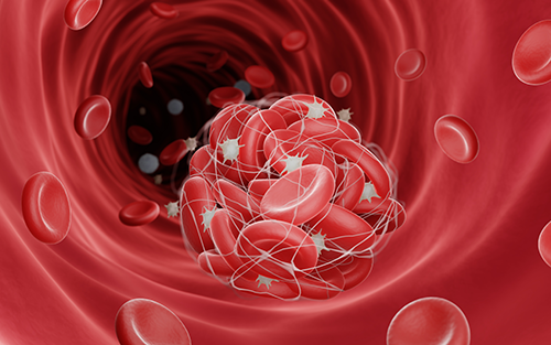 Thrombosis
